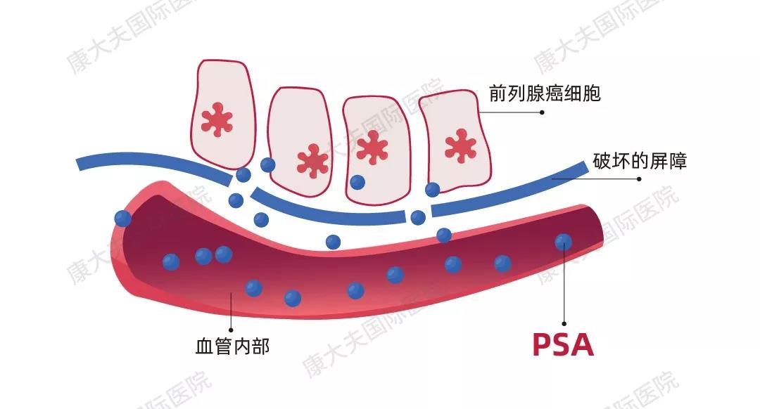 前列腺癌突破屏障释放PAS进入血管内示意图.jpg